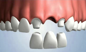 Lamesa Dental bridge service