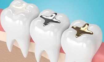 Lamesa Dental composite filling service