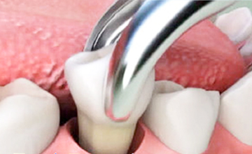 Lamesa Dental Tooth Extractions service