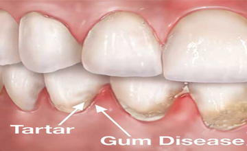 Lamesa Dental Periodontal (Gum) Disease service