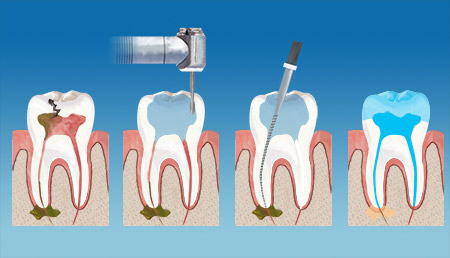 Lamesa Dental Endodontics Therapy service