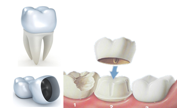 Porcelain crown placement procedure