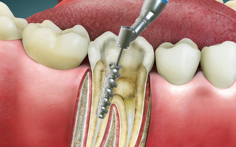 Root Canal Cary, NC - Cary Implant and General Dentistry