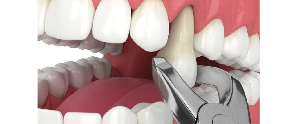 Tooth Extraction Lamesa