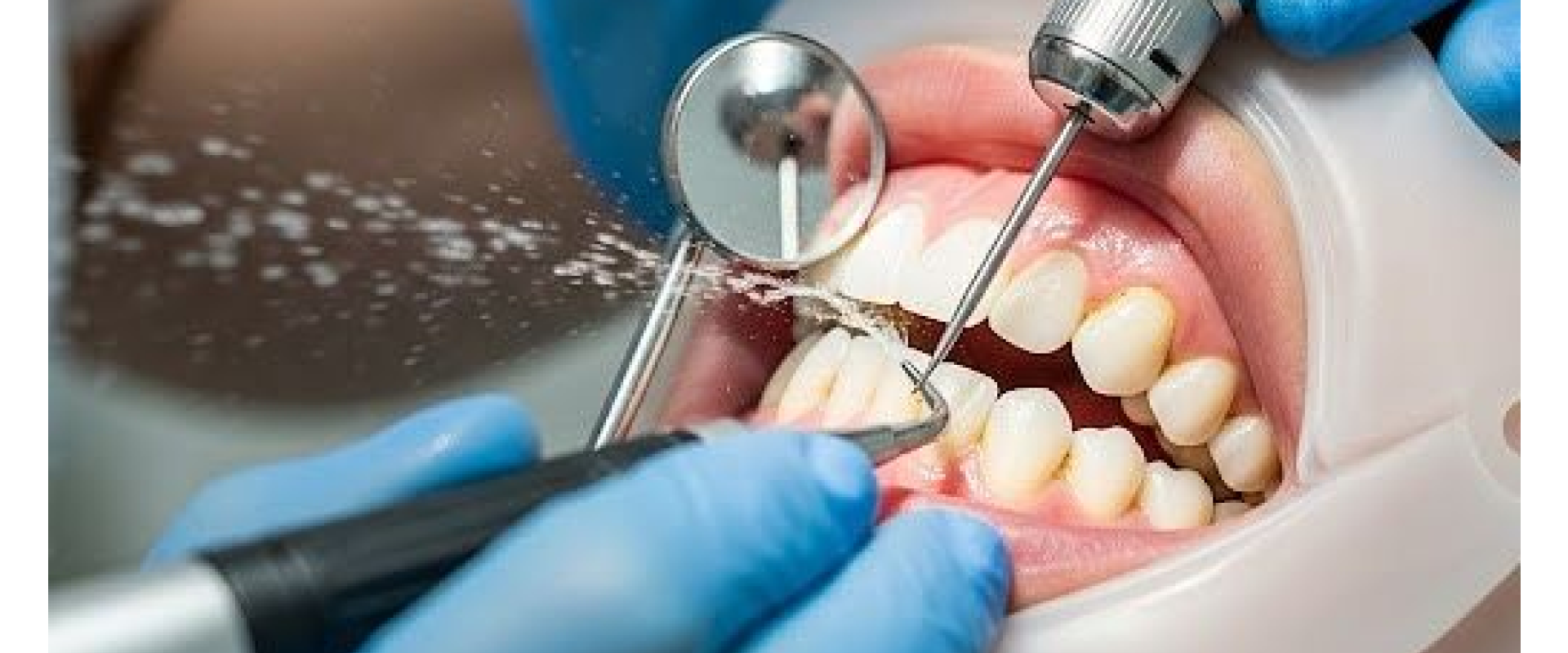 professional teeth cleaning Lamesa