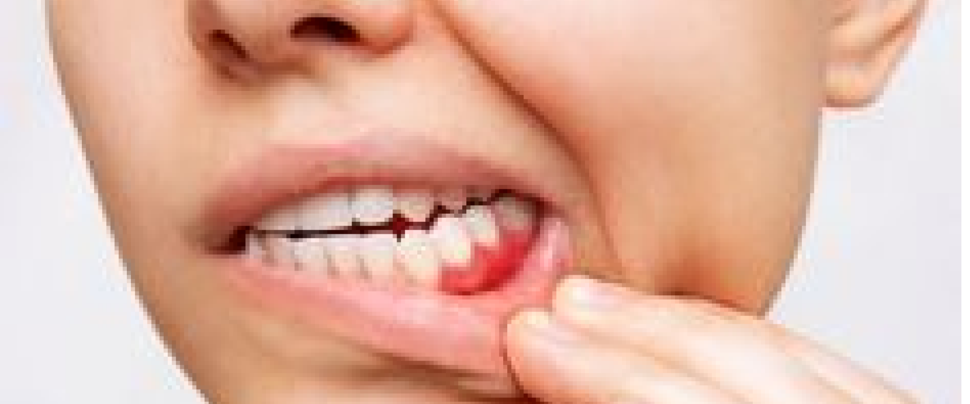 Oral Cancer Screenings
